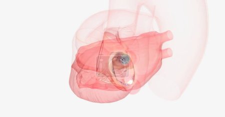 Photo for Mitral valve prolapse may cause the blood to flow backwards from the left ventricle into the left atrium. 3D rendering - Royalty Free Image