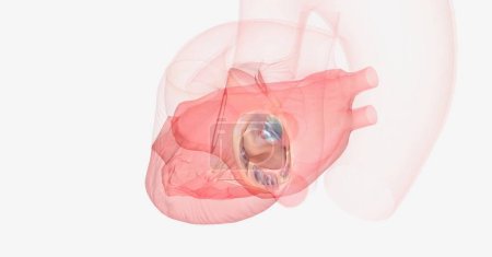 Téléchargez les photos : Le prolapsus de la valve mitrale peut provoquer un reflux sanguin du ventricule gauche vers l'oreillette gauche. rendu 3D - en image libre de droit