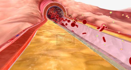Téléchargez les photos : Dans l'hyperlipidémie, l'excès de lipides peut s'accumuler sur les parois des artères et former une substance grasse appelée plaque. Expéditeur 3D - en image libre de droit