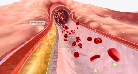Foto de La hiperlipidemia ocurre cuando las concentraciones de lípidos en el torrente sanguíneo son más altas de lo normal. Renderizado 3D - Imagen libre de derechos