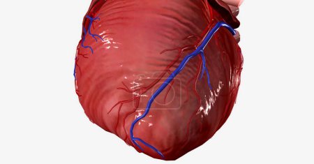 Photo for Once an atherosclerotic plaque reaches a certain size, it can occlude an artery completely or part of the plaque can rupture and form a clot, causing occlusion. 3D rendering - Royalty Free Image