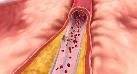 Foto de En la hiperlipidemia, el exceso de lípidos puede acumularse en las paredes arteriales y formar una sustancia grasa llamada placa. Renderizado 3D - Imagen libre de derechos