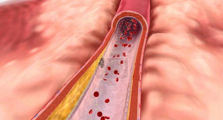 Foto de En la hiperlipidemia, el exceso de lípidos puede acumularse en las paredes arteriales y formar una sustancia grasa llamada placa. Renderizado 3D - Imagen libre de derechos
