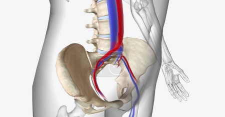May Thurner syndrome is compression of the left common iliac vein between the right common iliac artery and the 5th lumbar vertebra of the spine. 3D rendering