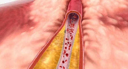 Foto de A medida que la hiperlipidemia continúa con el tiempo, la placa puede crecer y restringir el flujo sanguíneo a través de una arteria. Renderizado 3D - Imagen libre de derechos