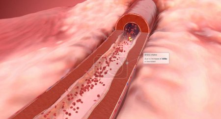 Foto de Los bloqueantes de los receptores de angiotensina II (ARA) ayudan a relajar las paredes musculares lisas de las arterias. La arteria se dilata, lo que resulta en una disminución de la presión arterial. Renderizado 3D - Imagen libre de derechos