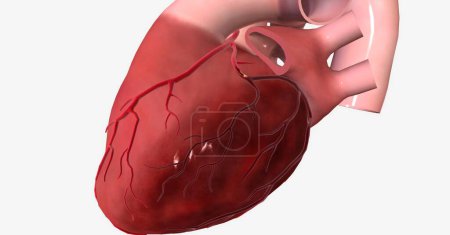 Foto de El infarto de miocardio (infarto de miocardio) es una afección grave que ocurre cuando se reduce el suministro de sangre y oxígeno al corazón, causando que parte del músculo cardíaco muera repentinamente. Renderizado 3D - Imagen libre de derechos