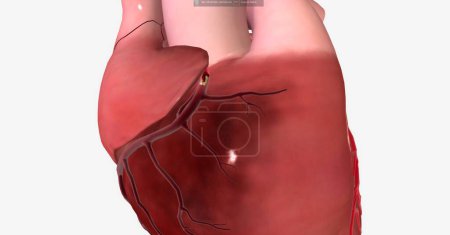 Téléchargez les photos : L'infarctus du myocarde (crise cardiaque) est une maladie grave qui survient lorsque l'apport de sang et d'oxygène au cœur est réduit, provoquant la mort soudaine d'une partie du muscle cardiaque. rendu 3D - en image libre de droit