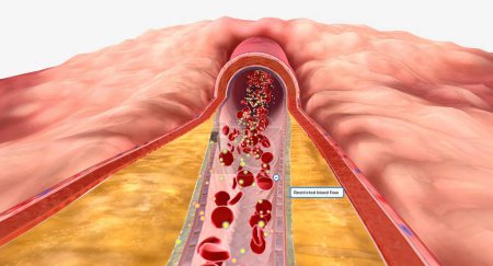 Foto de A medida que la hiperlipidemia continúa con el tiempo, la placa puede crecer y restringir el flujo sanguíneo a través de una arteria. Renderizado 3D - Imagen libre de derechos