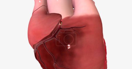 Photo for Myocardial infarction (heart attack) is a serious condition that occurs when blood and oxygen supply to the heart is reduced, causing part of the heart muscle to suddenly die. 3D rendering - Royalty Free Image