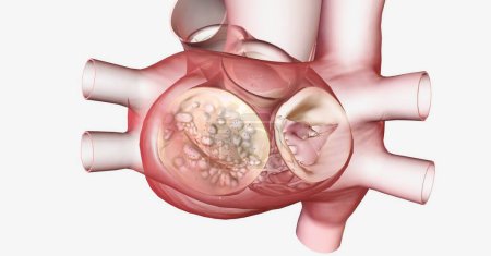 Foto de Comúnmente causada por infecciones como la fiebre reumática, la estenosis de la válvula mitral puede impedir la apertura y el cierre de la válvula. Renderizado 3D - Imagen libre de derechos