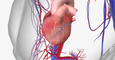 La isquemia miocárdica es causada por la reducción del flujo sanguíneo al corazón y la falta de oxígeno al músculo cardíaco. Renderizado 3D
