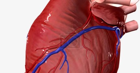 Sobald eine atherosklerotische Plaque eine bestimmte Größe erreicht hat, kann sie eine Arterie vollständig verschließen oder ein Teil der Plaque kann platzen und ein Blutgerinnsel bilden, das einen Verschluss verursacht. 3D-Rendering