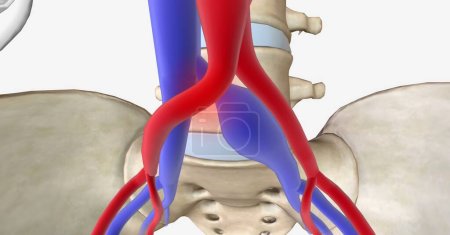 Foto de El síndrome de May Thurner es la compresión de la vena ilíaca común izquierda entre la arteria ilíaca común derecha y la quinta vértebra lumbar de la columna vertebral. Renderizado 3D - Imagen libre de derechos