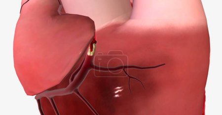 Foto de El infarto de miocardio (infarto de miocardio) es una afección grave que ocurre cuando se reduce el suministro de sangre y oxígeno al corazón, causando que parte del músculo cardíaco muera repentinamente. Renderizado 3D - Imagen libre de derechos