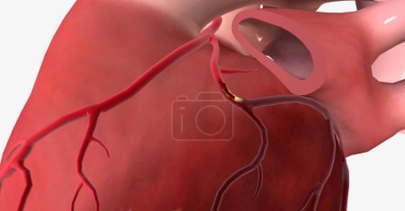 El infarto de miocardio (infarto de miocardio) es una afección grave que ocurre cuando se reduce el suministro de sangre y oxígeno al corazón, causando que parte del músculo cardíaco muera repentinamente. Renderizado 3D