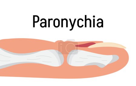 Illustration for Paronychia concepnt vector for medical blog, app, banner. Nail inflammation that may result from trauma, irritation or infection. It can affect fingernails or toenails. - Royalty Free Image