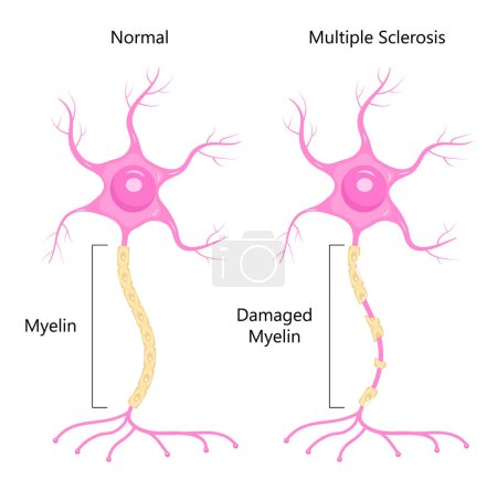 Ilustración de Neurón vector concepto. Dendrita, axón, soma de neurona. Esclerosis múltiple, ilustración de anatomía nerviosa. Mielina y núcleo de la célula cerebral. - Imagen libre de derechos