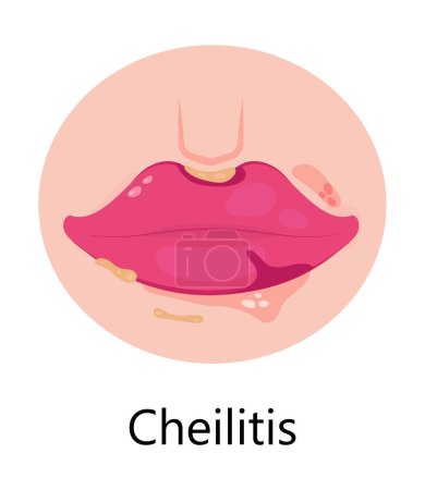 Herpes lips vector. Simplex virus infection causes recurring episodes of small, painful, fluid-filled blisters on skin, mouth, lips. Cheilitis is shown.