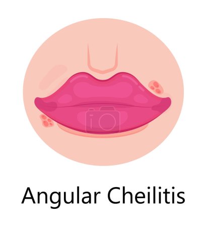 Illustration for Herpes lips vector. Simplex virus infection causes recurring episodes of small, painful, fluid-filled blisters on skin, mouth, lips. Cheilitis is shown. - Royalty Free Image