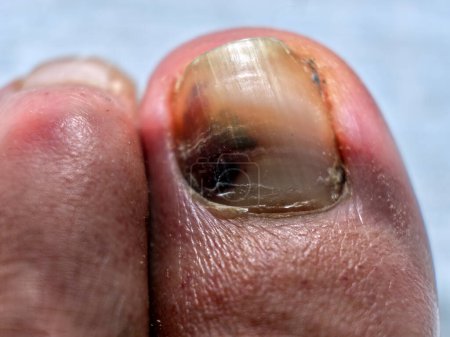 Téléchargez les photos : Subungual hematoma in a big toe. High quality photo - en image libre de droit