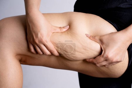 Cellulite leg woman pinch. Test fat hips treatment. Over weight liposuction. 