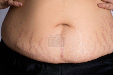 Foto de Vientre patrón de grasa del estómago mujer. - Imagen libre de derechos