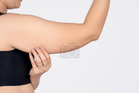 Photo of excess fat on the arm of a woman. Plastic surgery.
