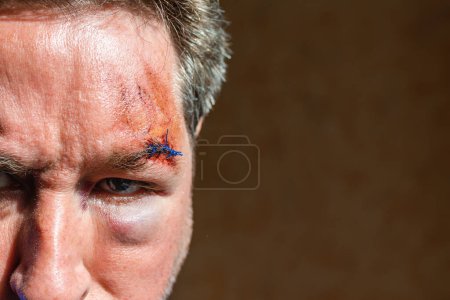 Téléchargez les photos : Blessure sur le sourcil d'un homme en colère après accident.scar forme cousu la peau après une opération avec une fibre bleue à la zone des sourcils.. - en image libre de droit