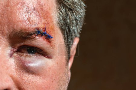 Téléchargez les photos : Blessure sur le sourcil d'un homme en colère après accident.scar forme cousu la peau après une opération avec une fibre bleue à la zone des sourcils.. - en image libre de droit