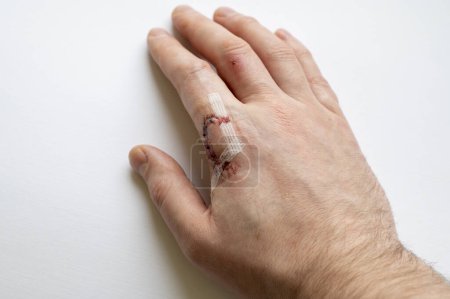 Detailed view of a wounded finger with juncture, blood seeping through, against a white background