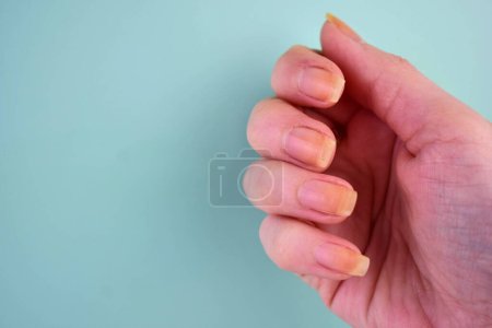 Damaged and yellowed nails of a woman on a blue background.Copy space.