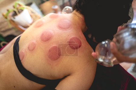 Téléchargez les photos : Patiente adolescente dans une thérapie de médecine traditionnelle chinoise avec des ecchymoses dans la peau du dos après une séance de tasses avec des tasses chauffées - en image libre de droit