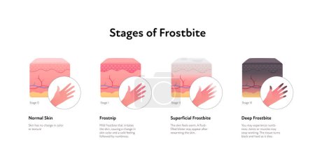 Frostbite anatomical infographic. Vector flat healthcare illustration. Stages of hypothermia. Skin layers and hand with finger healthy, frostnip, superficial and deep stage. Design for dermatology