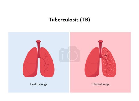 Concepto de enfermedad tuberculosa. Ilustración sanitaria plana vectorial. Pulmón sano e infectado sobre fondo rojo y azul. Elemento de diseño para atención de la salud, educación, neumología