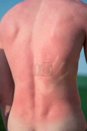 Foto de Hombre de espalda doloroso quemado por el sol junto al mar. - Imagen libre de derechos