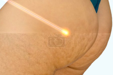 Photo for Concept repair cellulite skin with a laser - Royalty Free Image