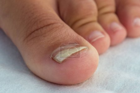 Foto de Imagen cercana de un dedo con infección por hongos en las uñas. - Imagen libre de derechos