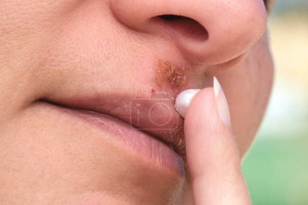 Herpes on the lip close-up. Woman lubricates the labial herpes ointment.