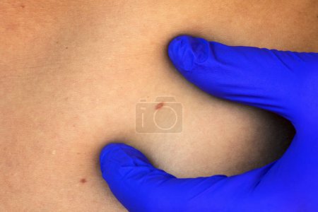 Téléchargez les photos : Gros plan, dermatologue médecin examine le dépistage préventif du cancer de la peau. - en image libre de droit