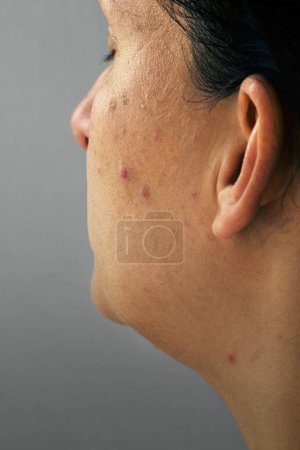 Foto de Mujer con piel problemática y acné, primer plano - Imagen libre de derechos