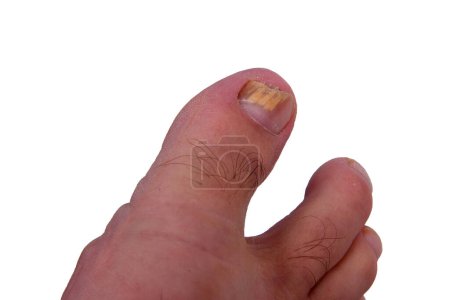 Infección por hongos en las uñas del dedo gordo del pie. Infección fúngica en las uñas de los pies con tiña onicomicosis, resultado de la enfermedad