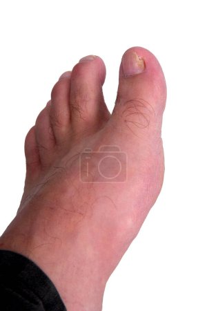 Téléchargez les photos : Infection par les champignons des ongles sur le gros orteil. Infection fongique sur les ongles orteil avec teigne onychomycose, résultat de la maladie - en image libre de droit