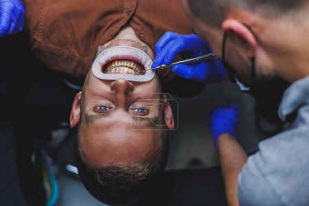 Foto de Tratamiento dental de los dientes. Un joven en una cita con un dentista. El médico instala frenos de metal en los dientes. Primer plano de los dientes con aparatos ortopédicos - Imagen libre de derechos