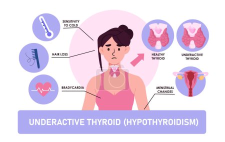 Illustration for Hypothyroidism sypmthoms set. Woman with underactive thyroide, bradycardia, hair loss and menstrual changes. Medical infographic. Cartoon flat vector collection isolated on white background - Royalty Free Image