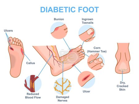 Ilustración de Diagrama médico del pie diabético. Infografías con síntomas de diabetes y enfermedad por resistencia a la insulina. Tratamiento y prevención. Ilustración vectorial plana de dibujos animados aislada sobre fondo blanco - Imagen libre de derechos