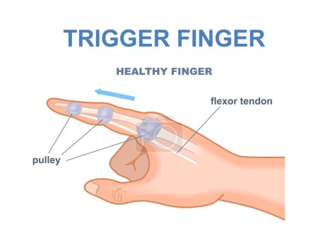 Illustration for Trigger finger concept. Medical infographics and educational materials. Biology and anatomy. Template and layout. Cartoon flat vector illustration isolated on white background - Royalty Free Image