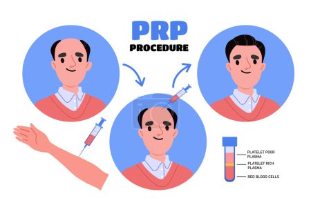 Prp procedure concept. Medical infographics and educational materials. Fght against hair loss. Health care, diagnosis and treatment. Cartoon flat vector illustration isolated on white background