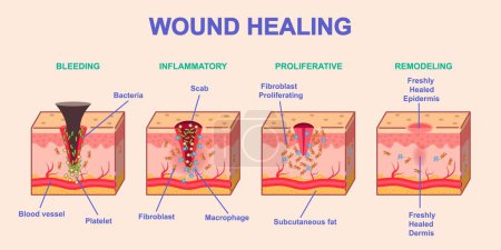 Illustration for Wound healing process. Medical infographics or diagram with stages or phases of skin regeneration after injury. Bleeding, Inflammation, Proliferation and Remodeling. Cartoon flat vector illustration - Royalty Free Image
