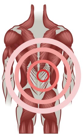 Illustration for Muscles of the back radiating pain. No meshes used. - Royalty Free Image